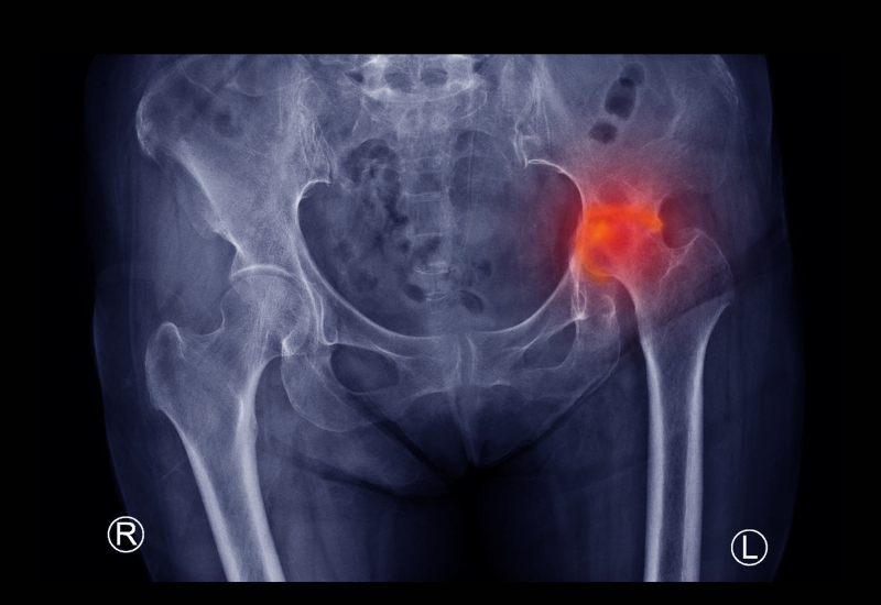 IRM Hospital - Excellence in Avascular Necrosis (AVN) Treatment