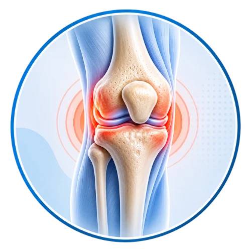 Knee joint affected by arthritis